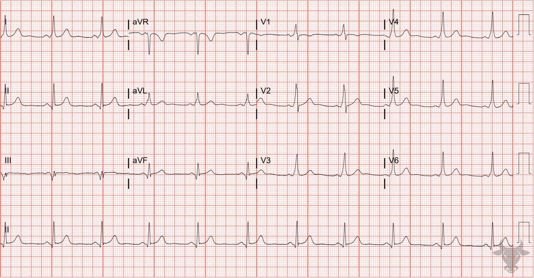 ECG Showing Ventricular Pre-excitation