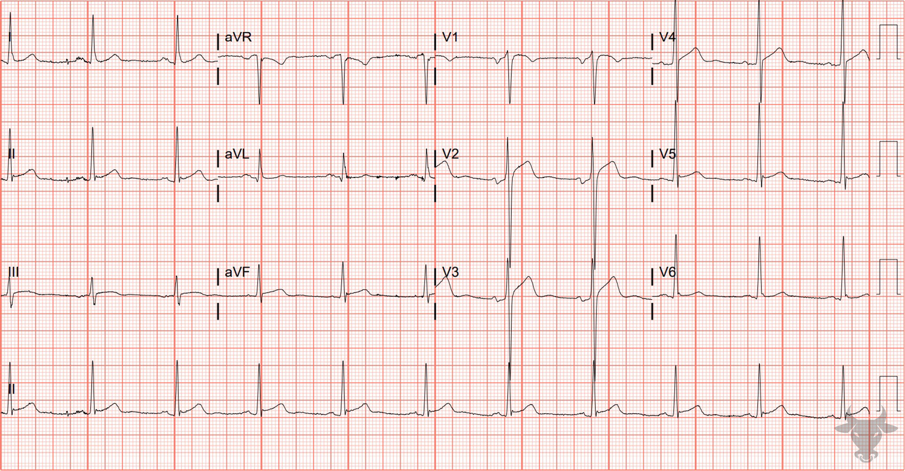 ECG Showing Left Ventricular Hypertrophy