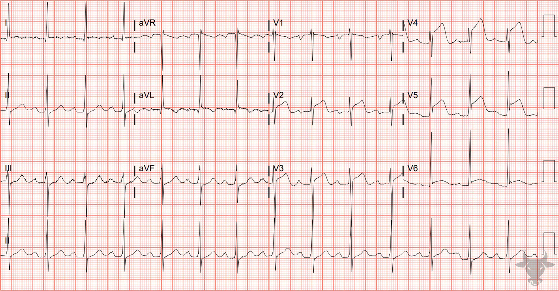 ECG Showing Anterior ST-elevation Myocardial Infarction