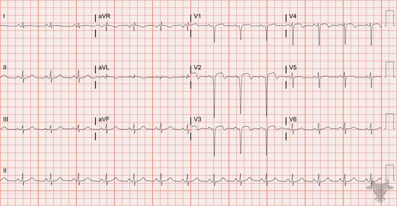 poor-r-wave-progression-ecg-stampede