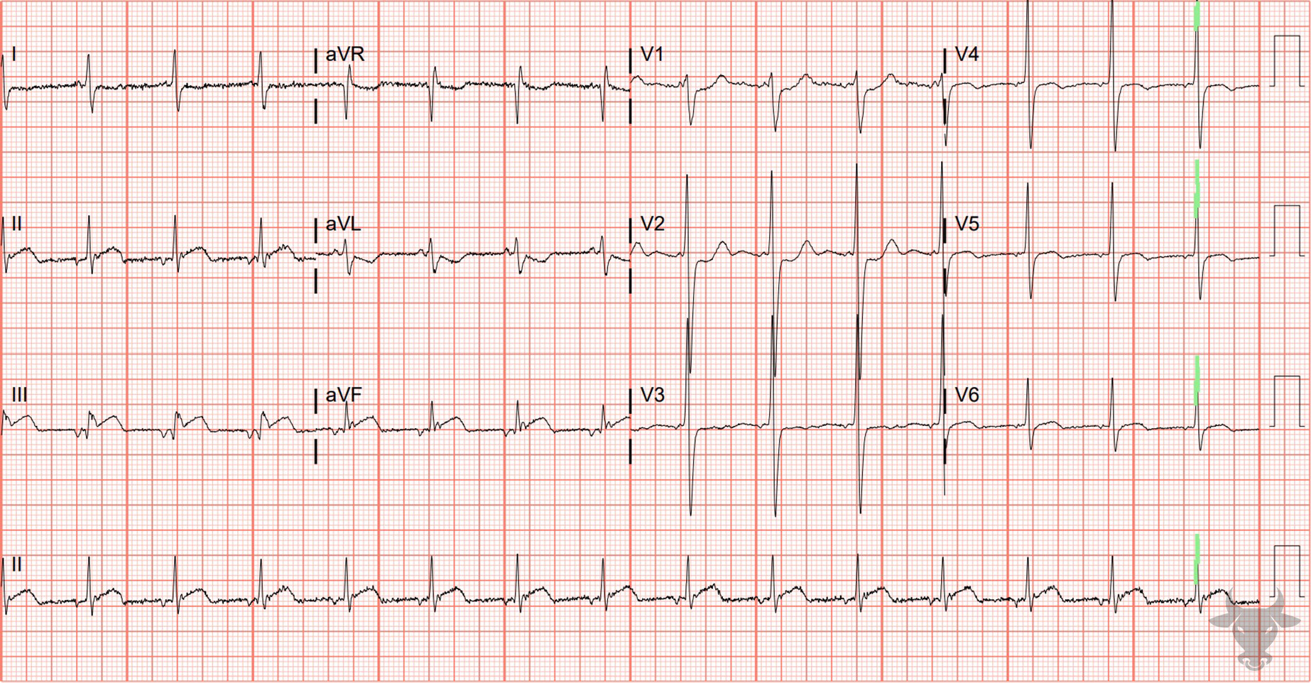 ECG Showing ST-elevation Myocardial Infarction