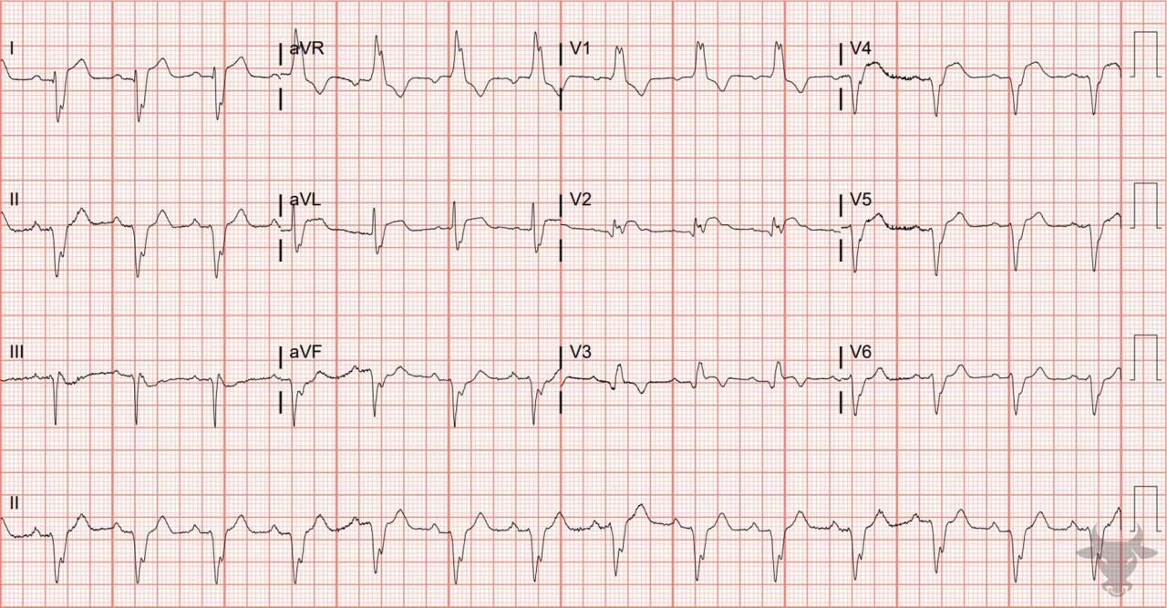 Bifascicular Block ECG Stampede