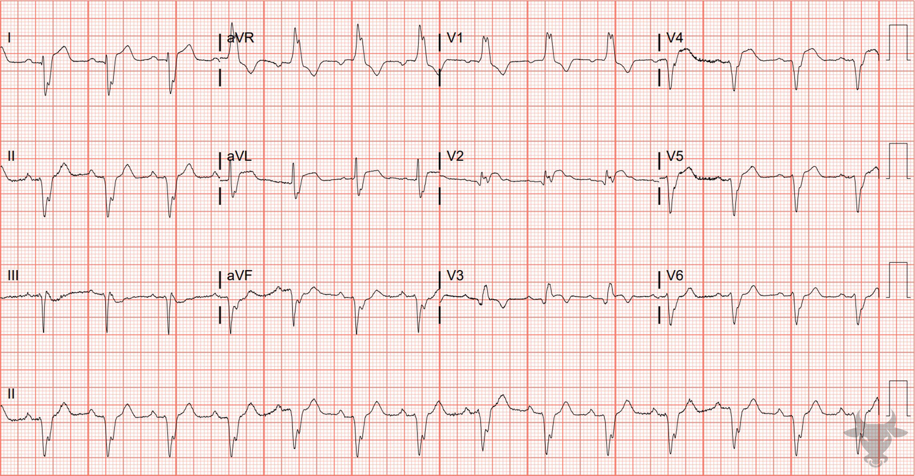 ECG Showing ST-elevation Myocardial Infarction