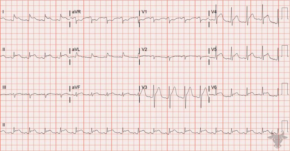 Acute Pericarditis | ECG Stampede