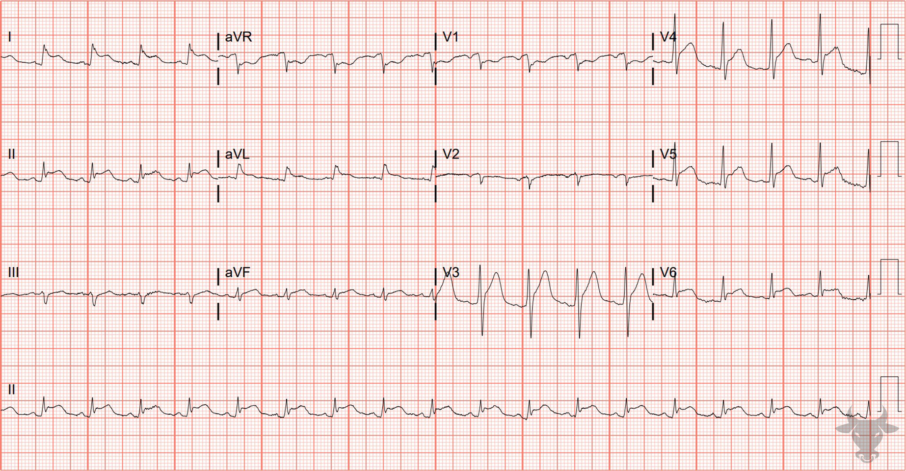 ECG Showing Acute Pericarditis