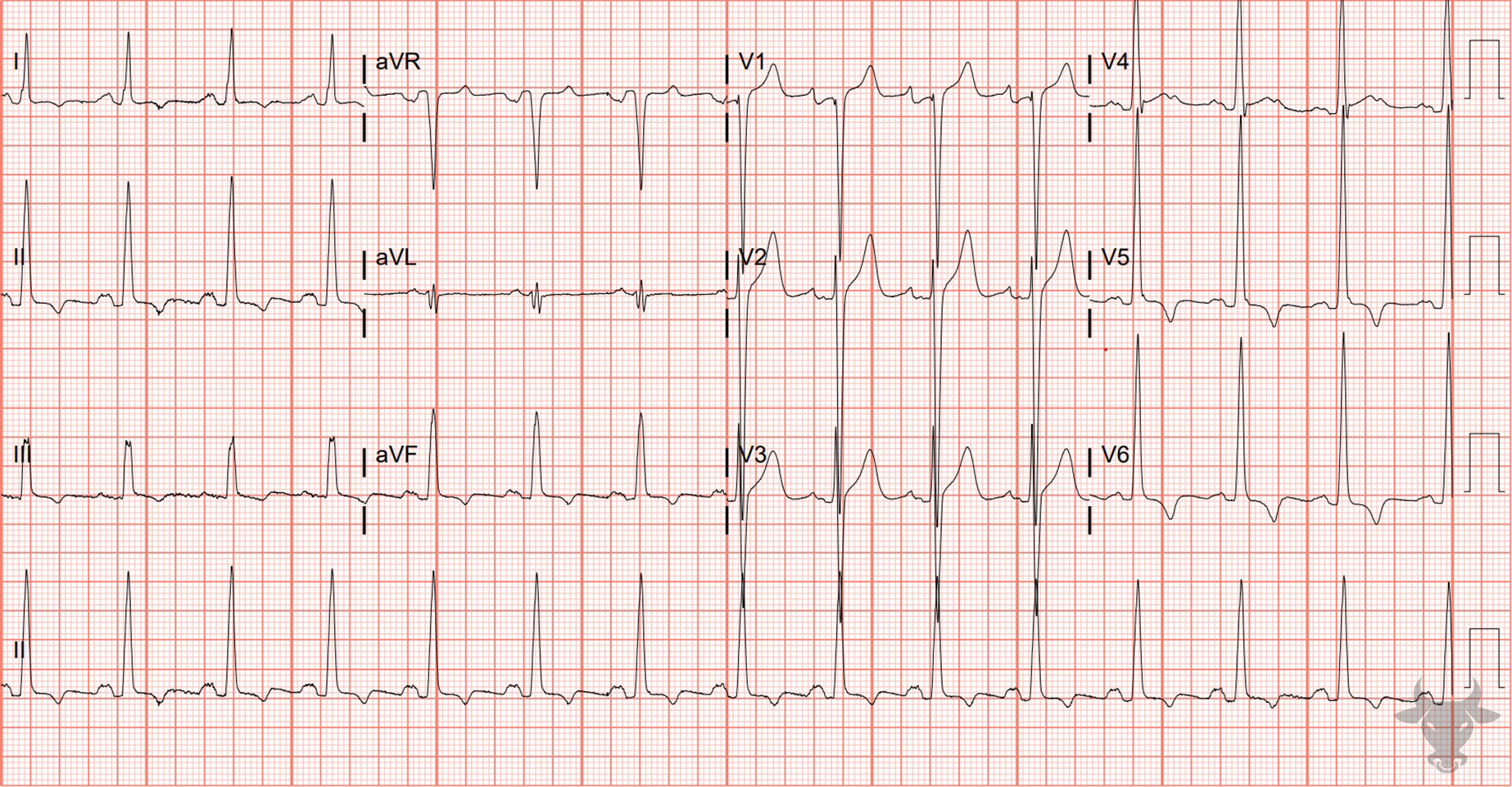 ECG Showing Left Ventricular Hypertrophy