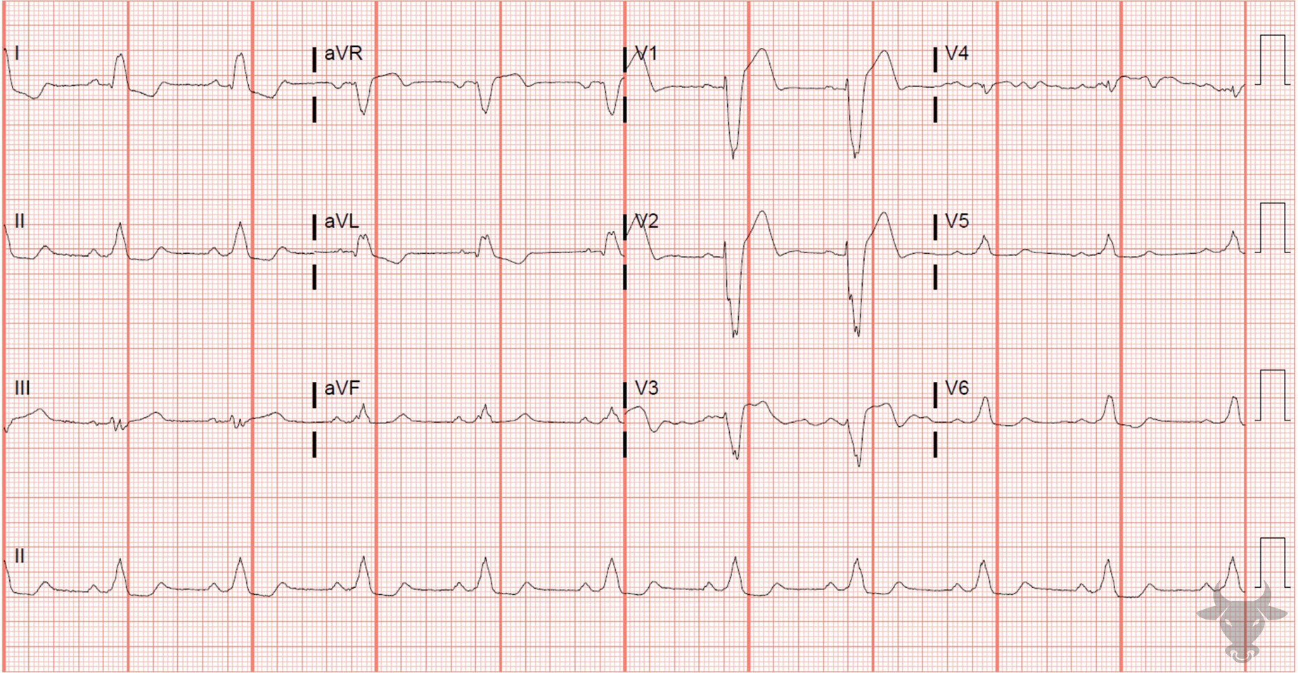 ECG Showing Sgarbossa Criteria