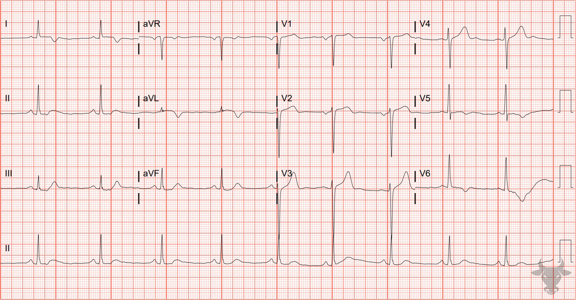 ECG Showing Left Ventricular Hypertrophy