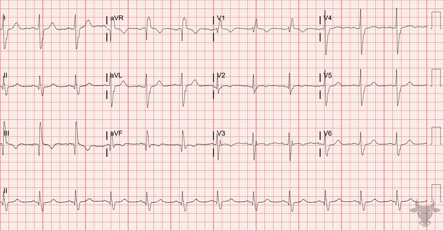 ECG Showing Right Bundle Branch Block & Left Posterior Fascicular Block