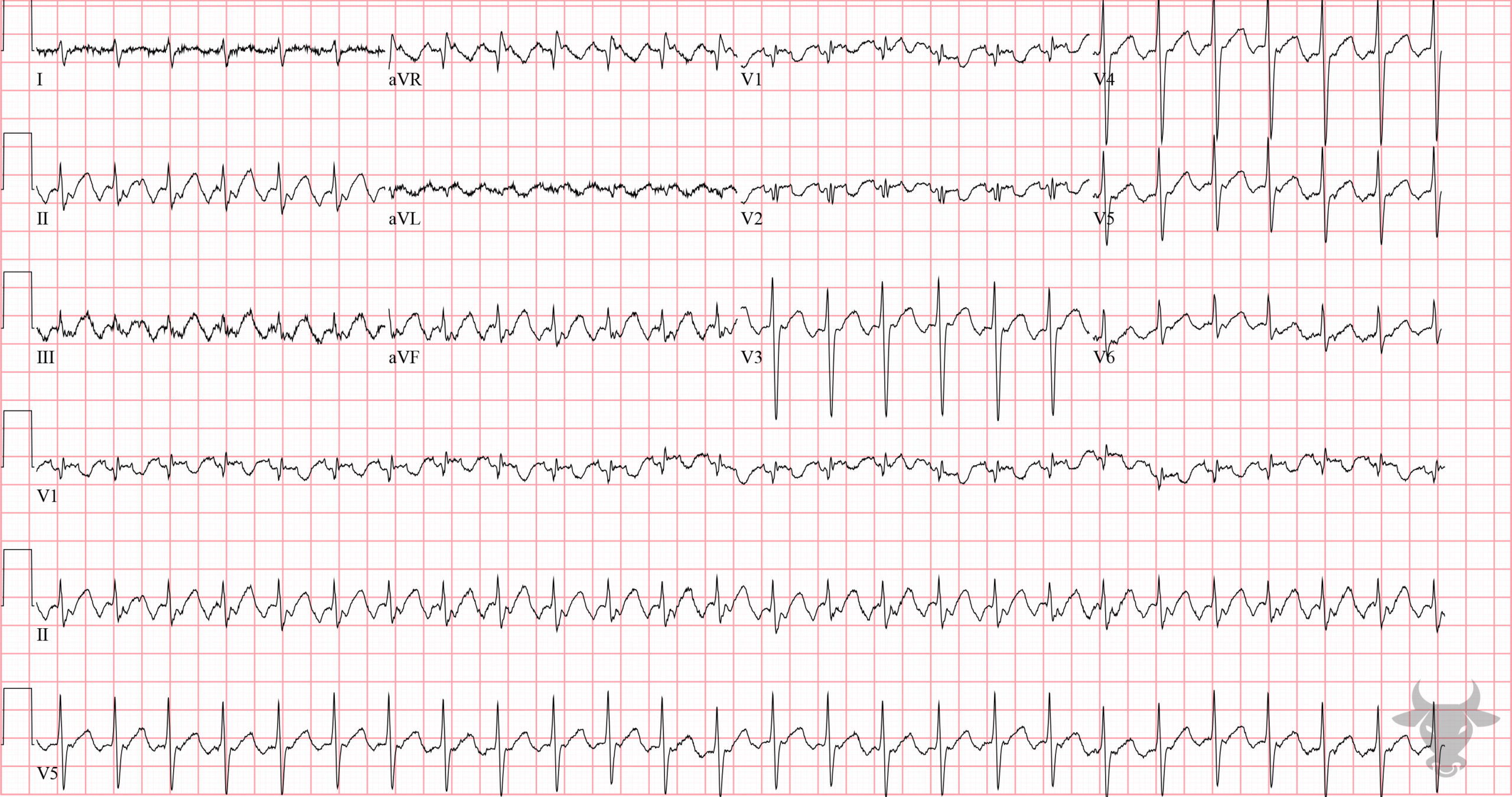 ECG Showing Atrial Flutter