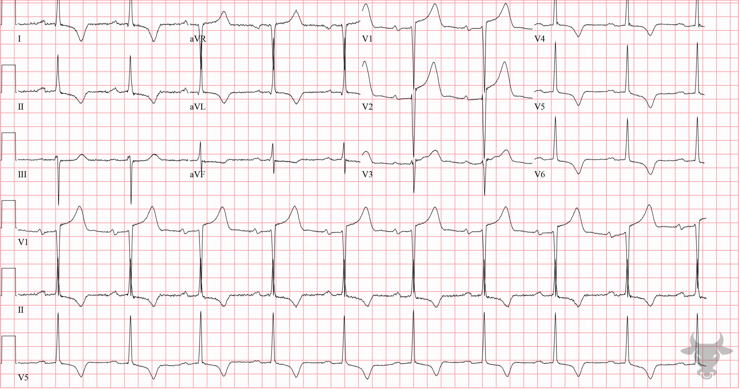 ECG Showing Left Ventricular Hypertrophy