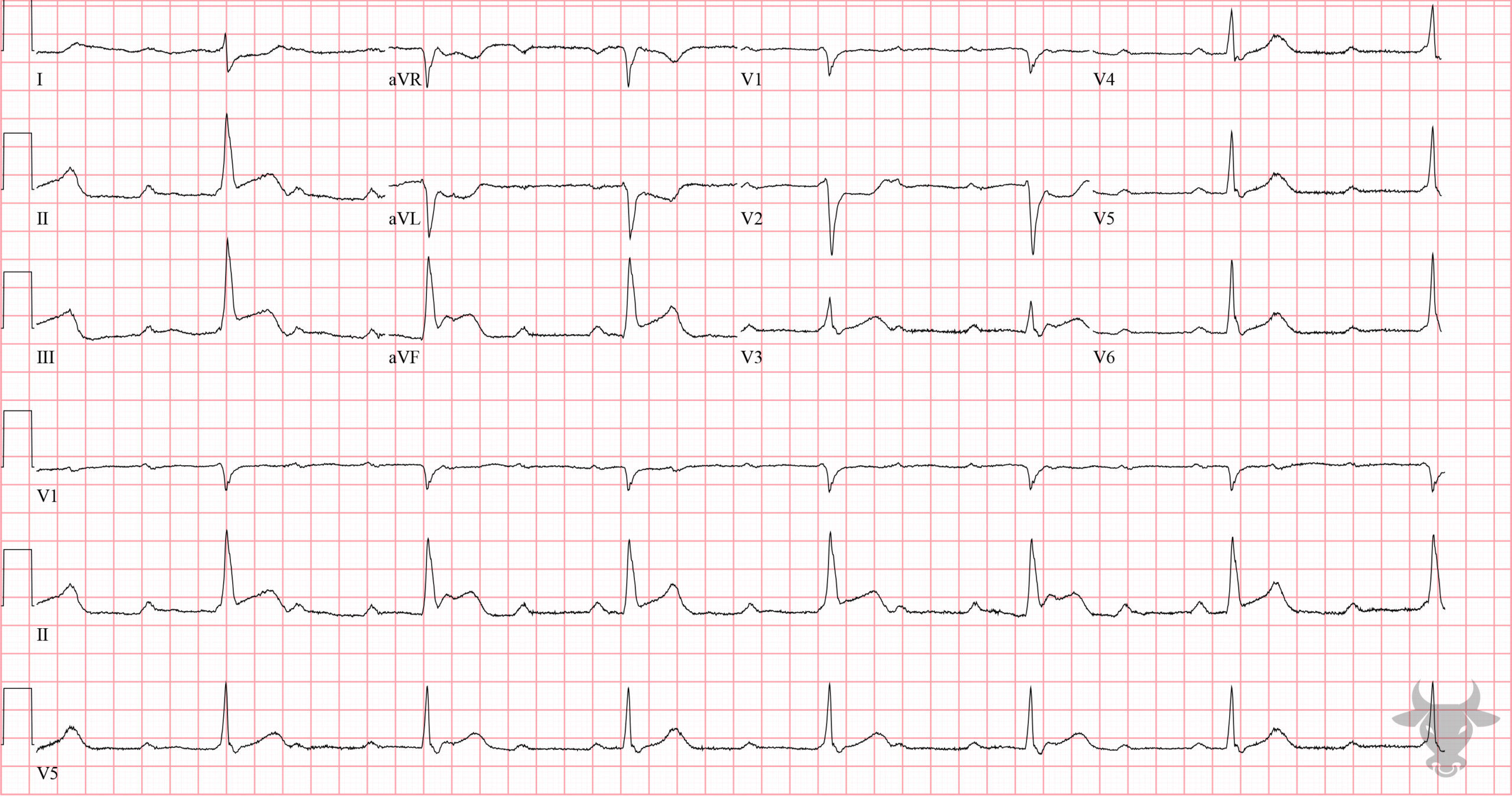 ECG Showing Third Degree Atrioventricular Block