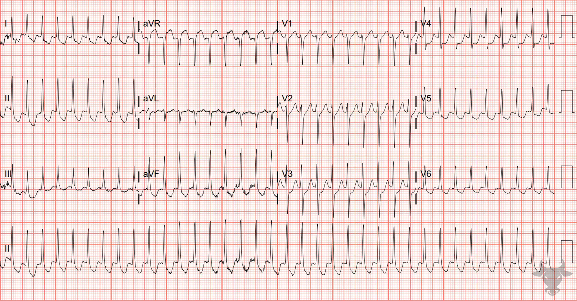 ECG Showing Atrioventricular Reentrant Tachycardia