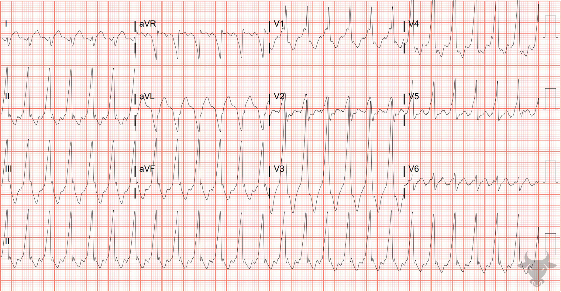 ECG Showing Antidromic Atrioventricular Reentrant Tachycardia