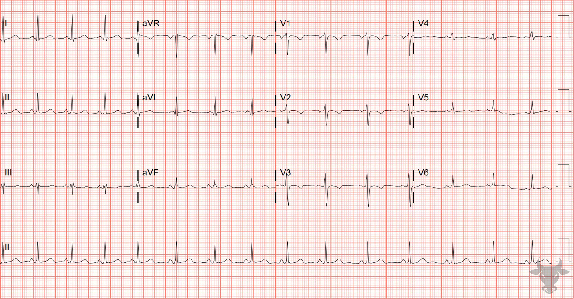 ECG Showing Persistent Juvenile T Wave Pattern