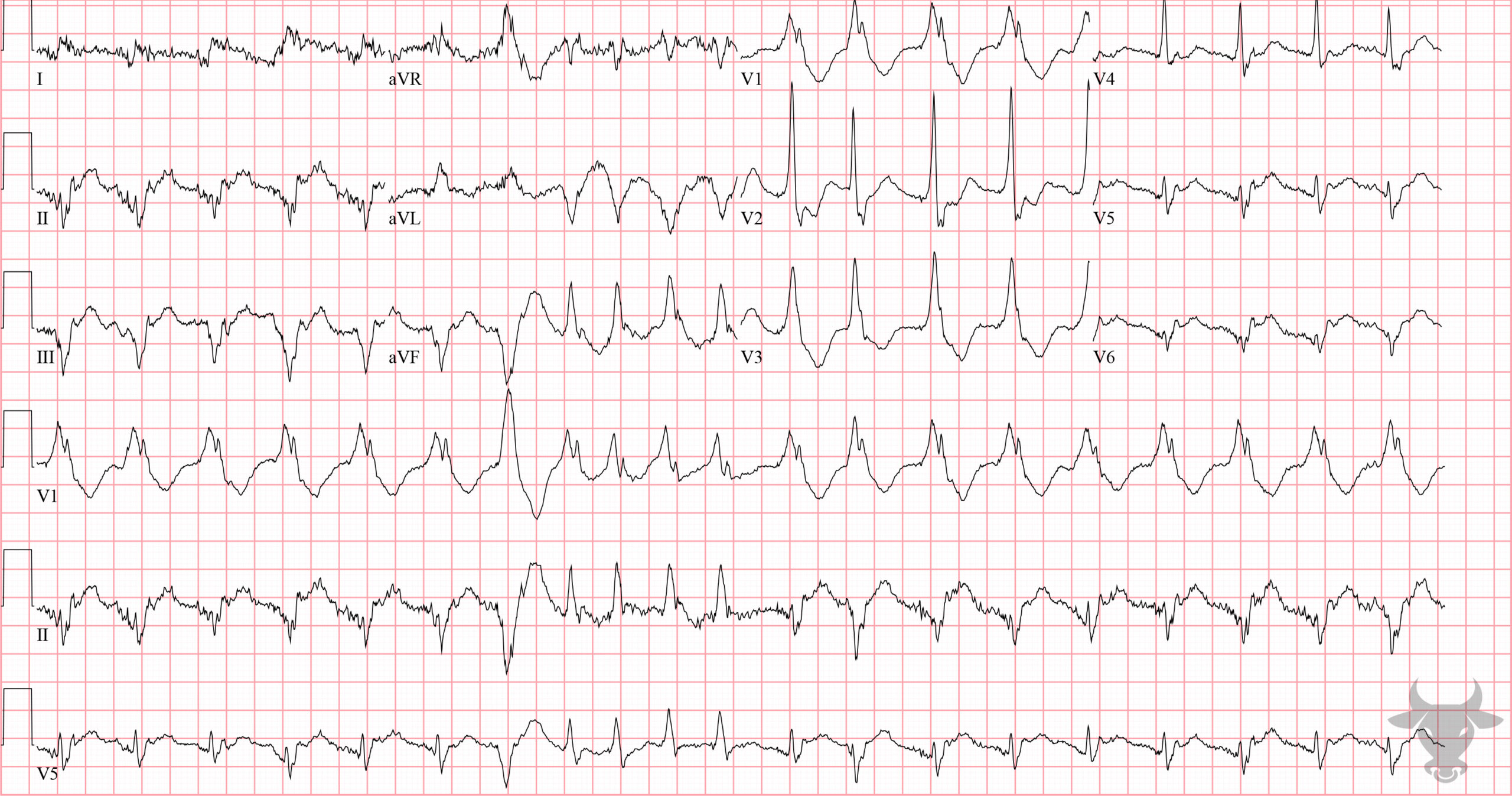 ECG Showing Ventricular Tachycardia