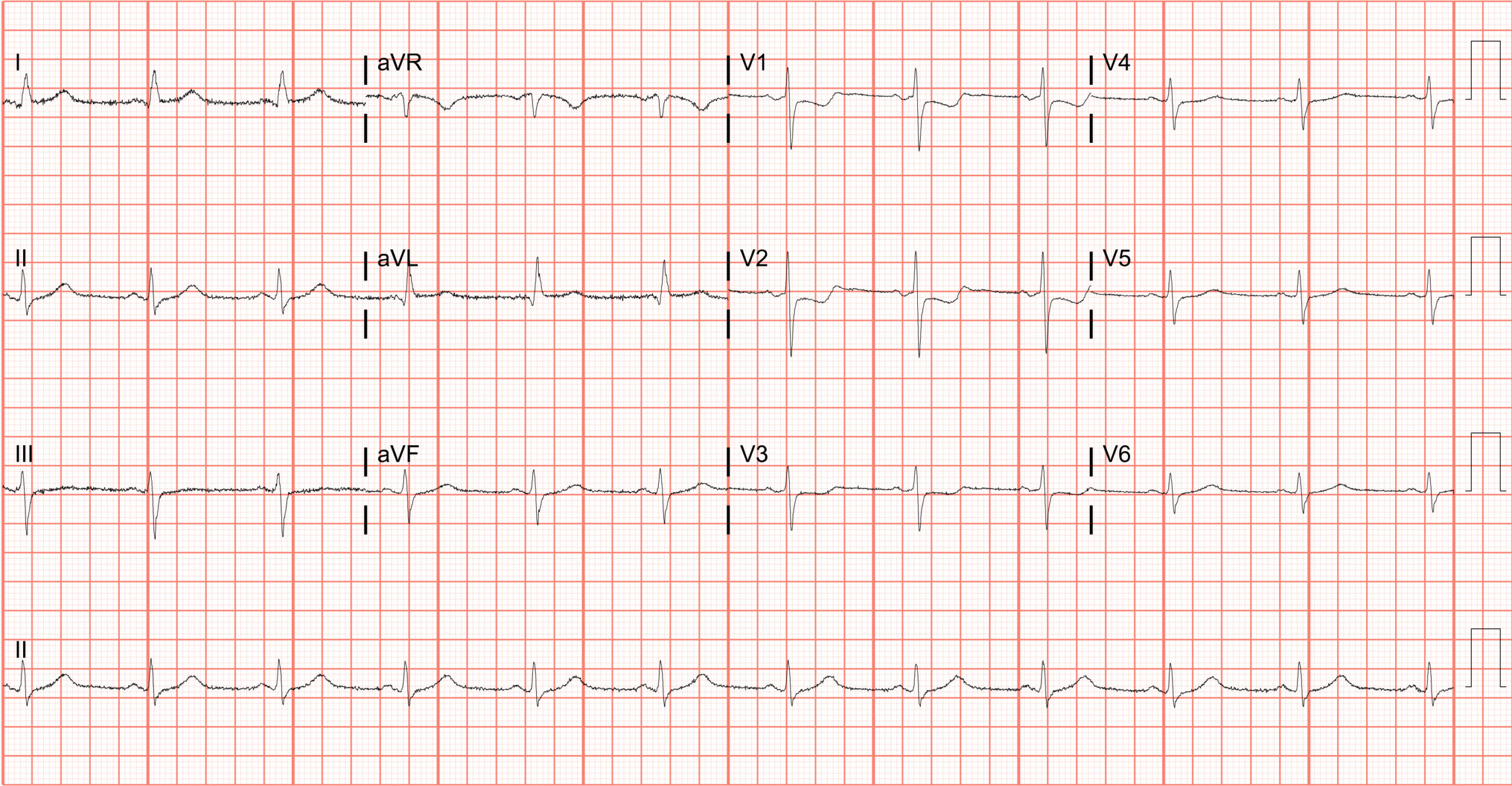 ECG Showing Posterior Myocardial Infarction