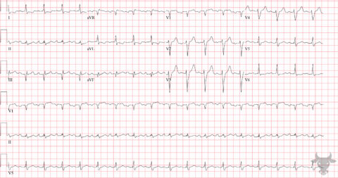 Aslanger Pattern | ECG Stampede