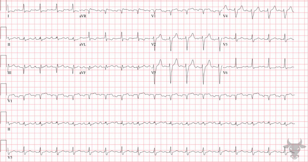 Aslanger Pattern | ECG Stampede