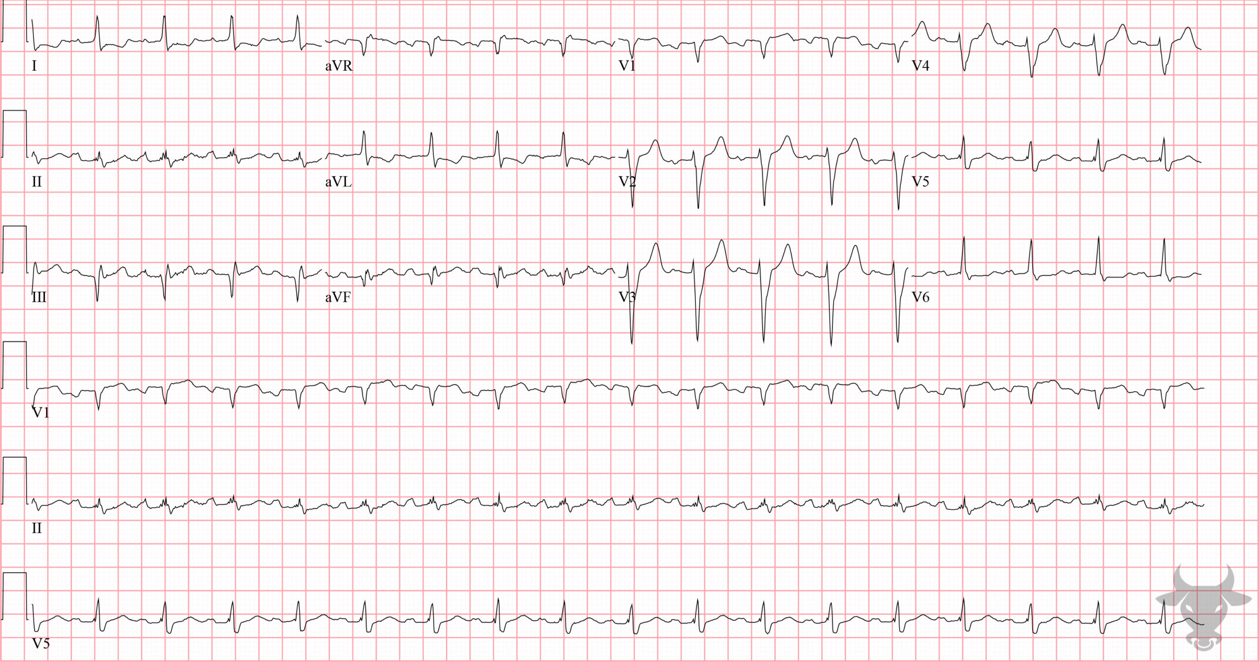 ECG Showing Aslanger Pattern