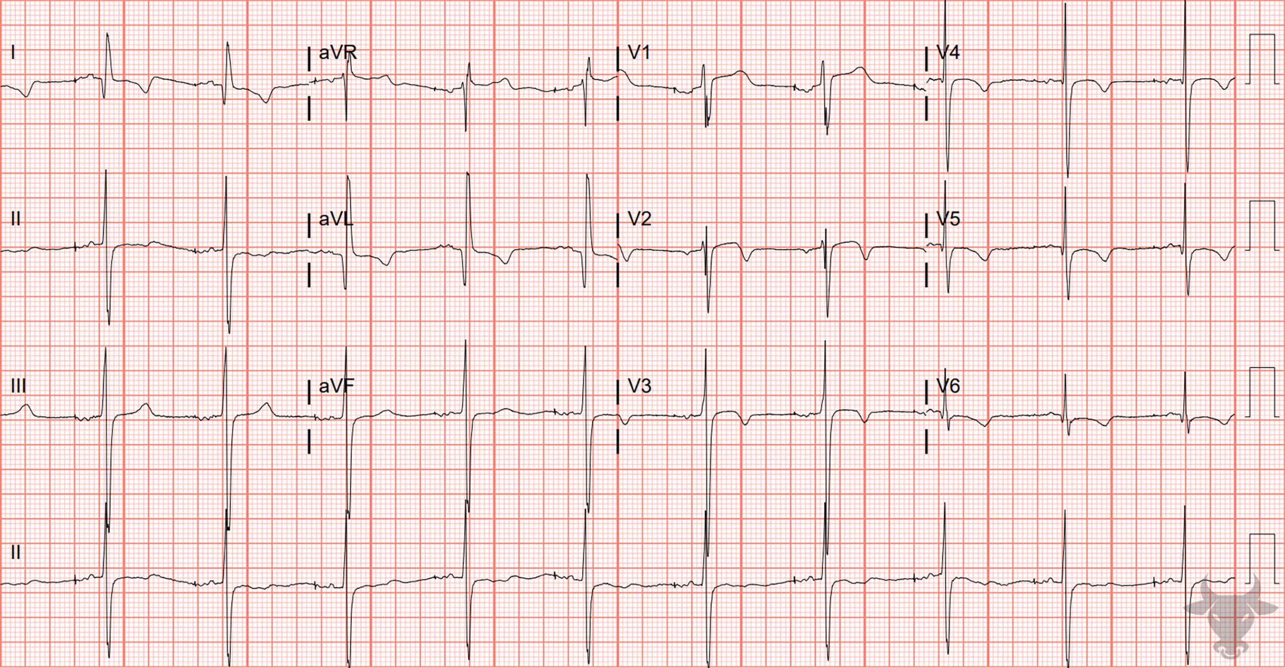 ECG showing hypertrophic cardiomyopathy