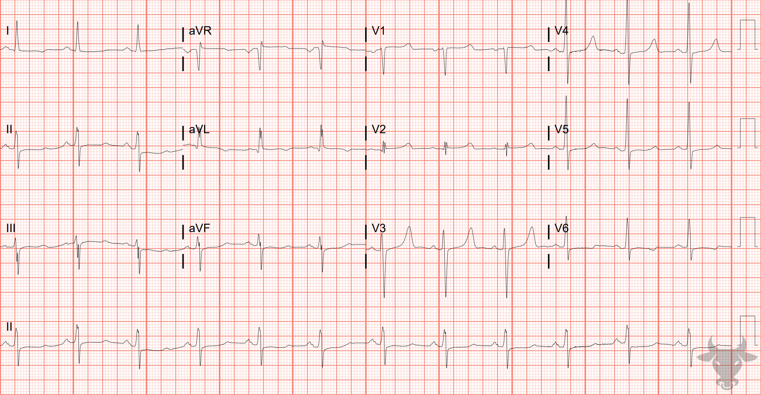 ECG Showing Hypercalcemia