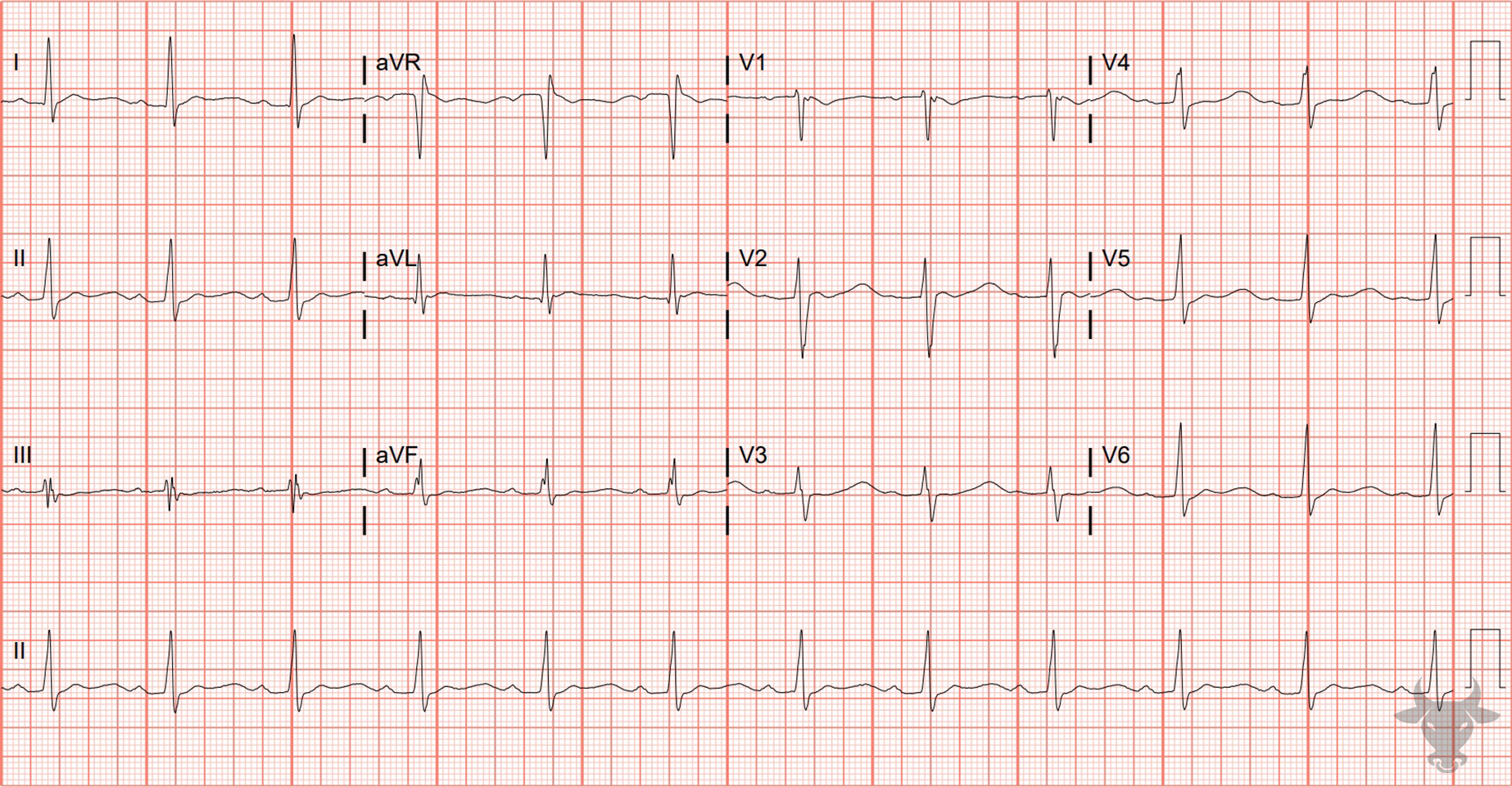 ECG Showing Hypokalemia