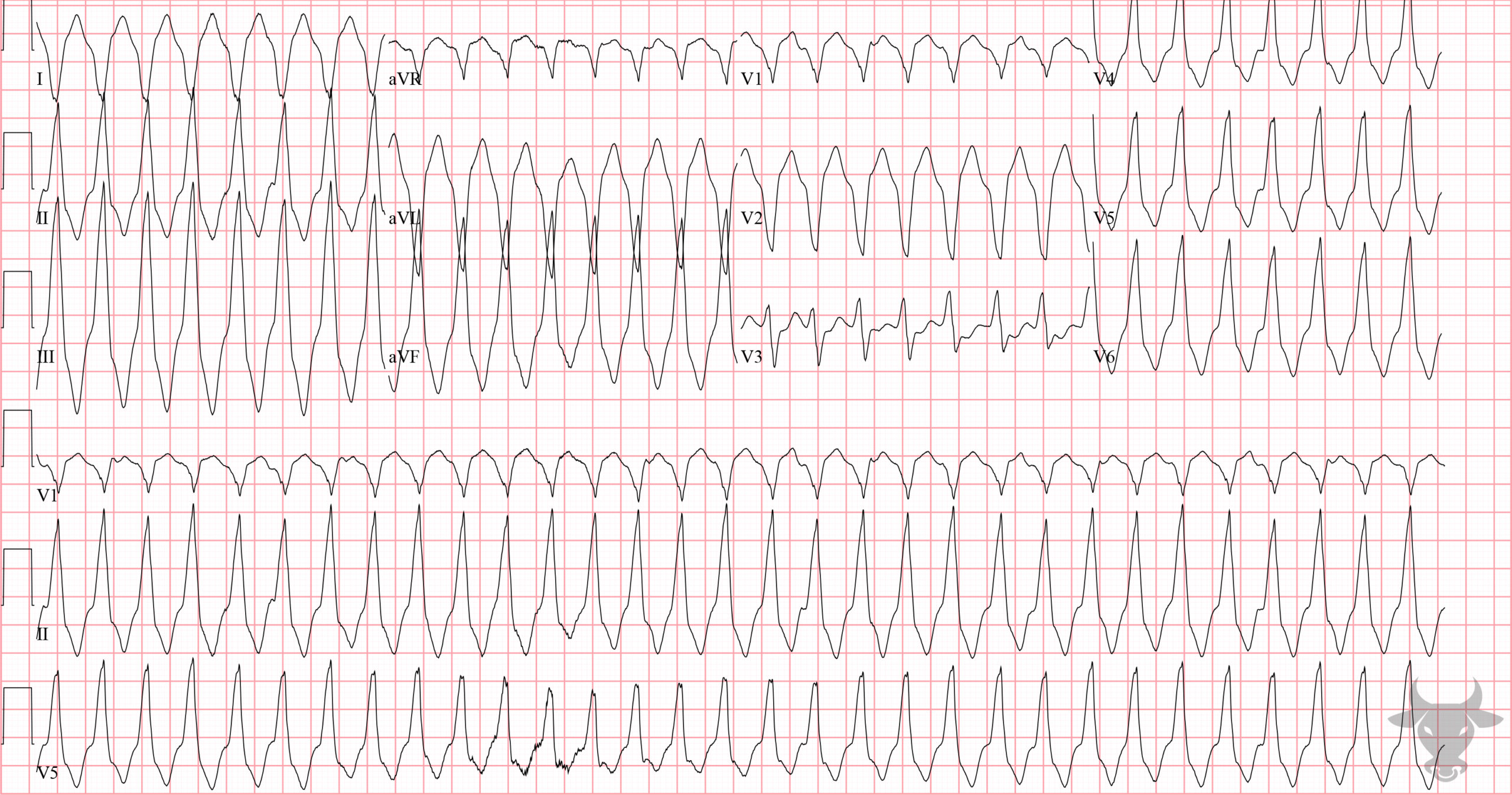 ECG Showing Ventricular Tachycardia