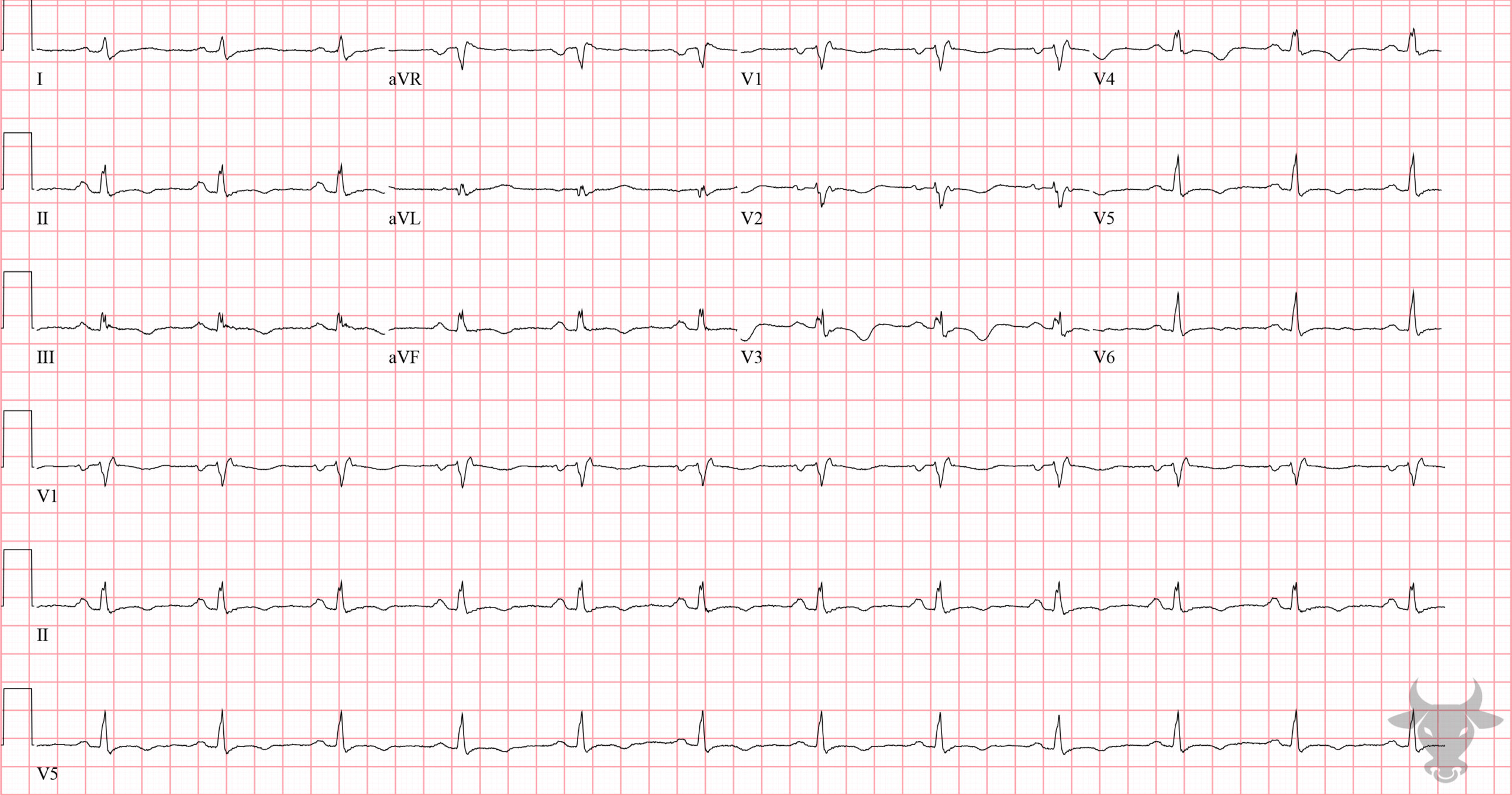 ECG Showing Arrhythmogenic Right Ventricular Cardiomyopathy