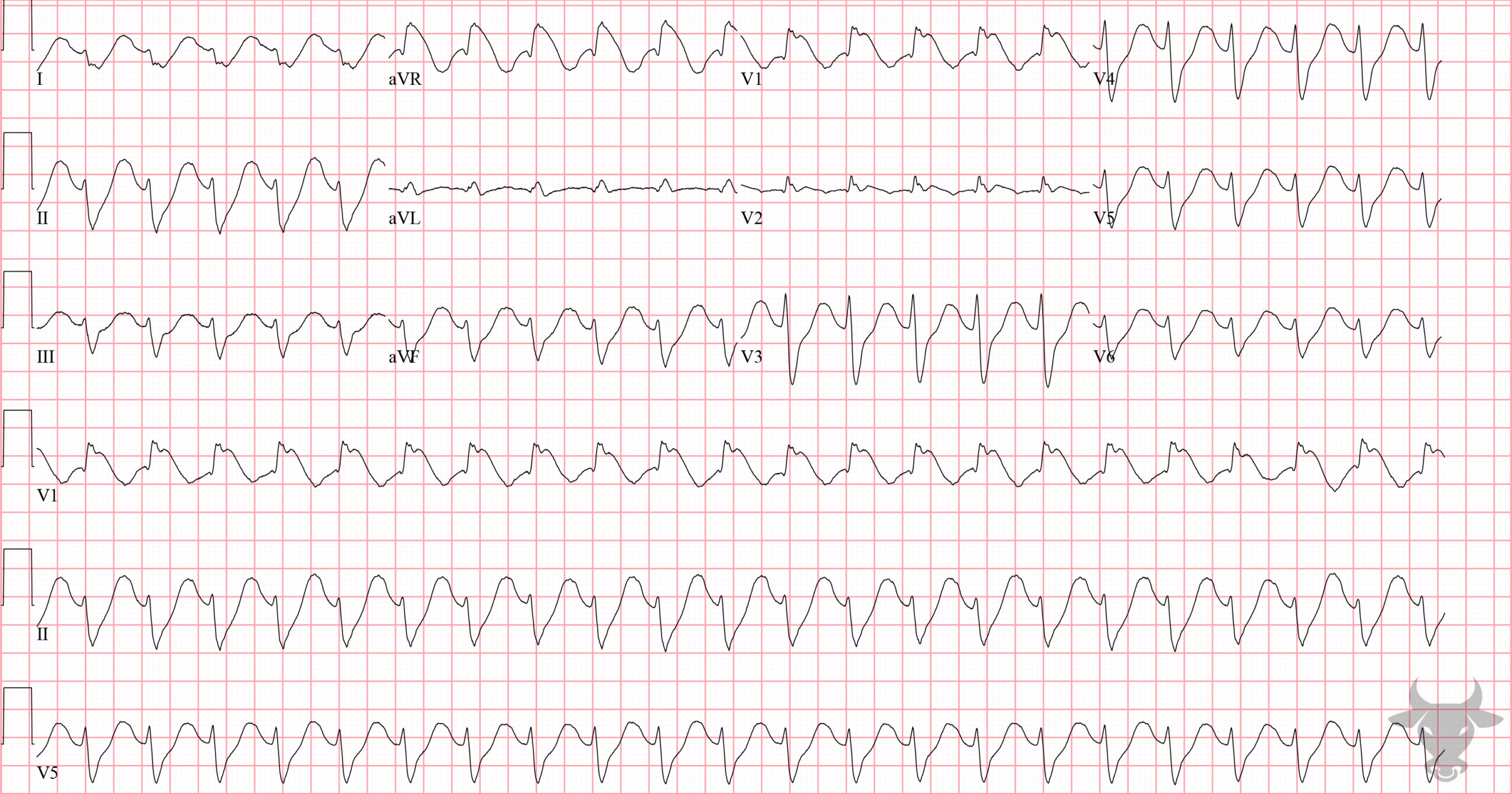 ECG Showing Sodium Channel Toxicity