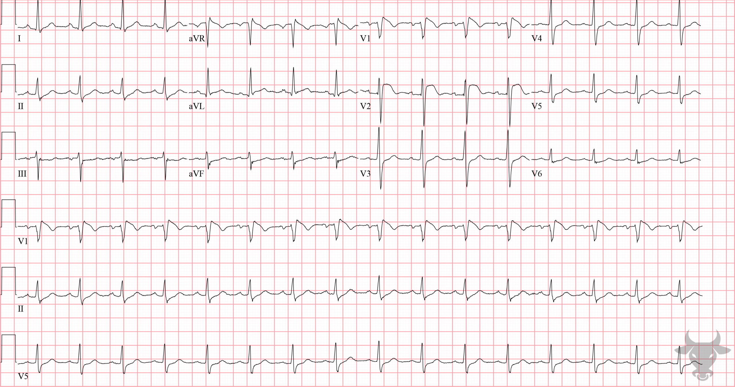 ECG Showing Brugada Syndrome