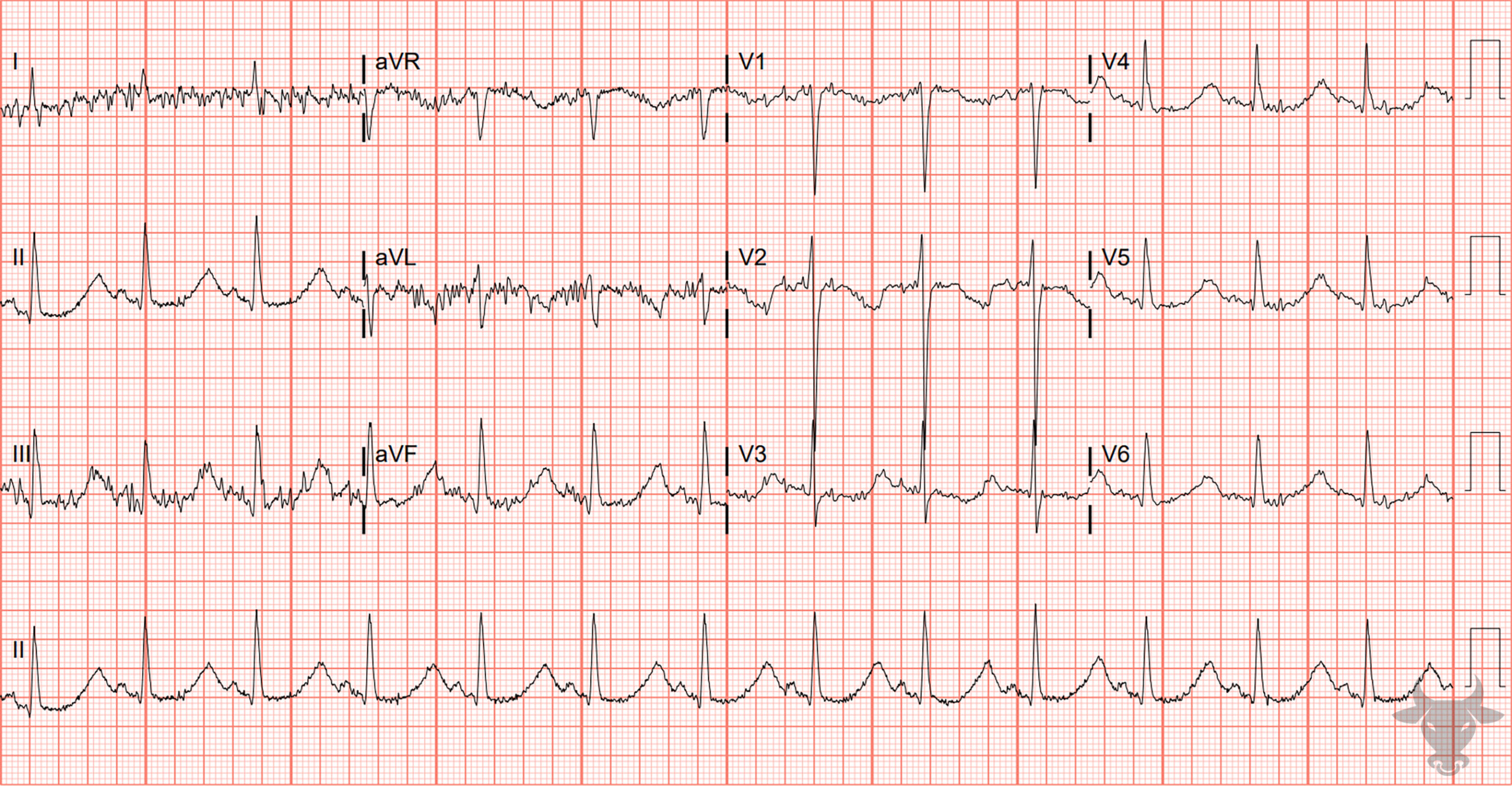 ECG Showing Hypokalemia