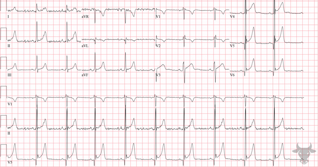 Early Repolarization | ECG Stampede