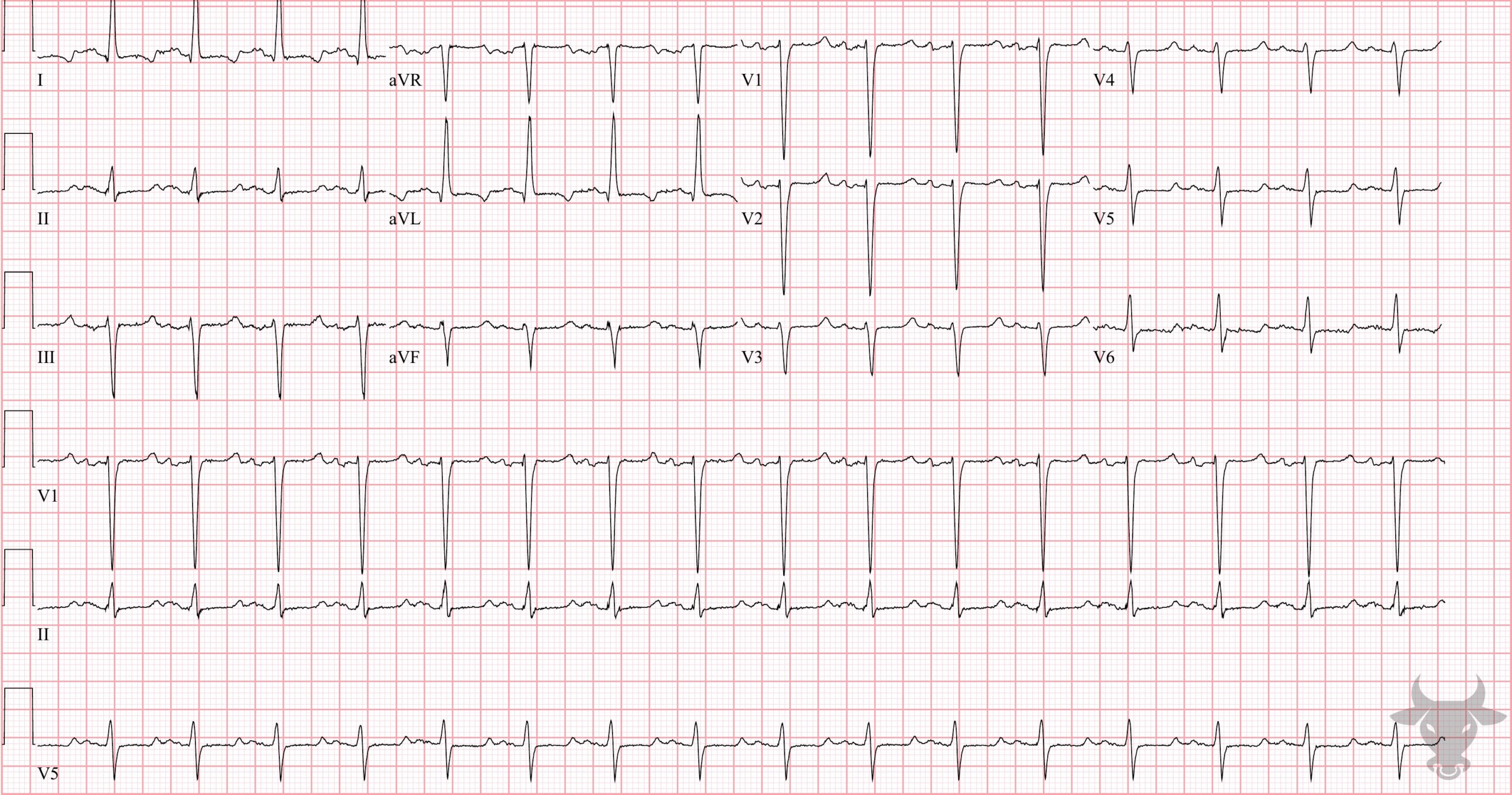 ECG Showing Hypocalcemia