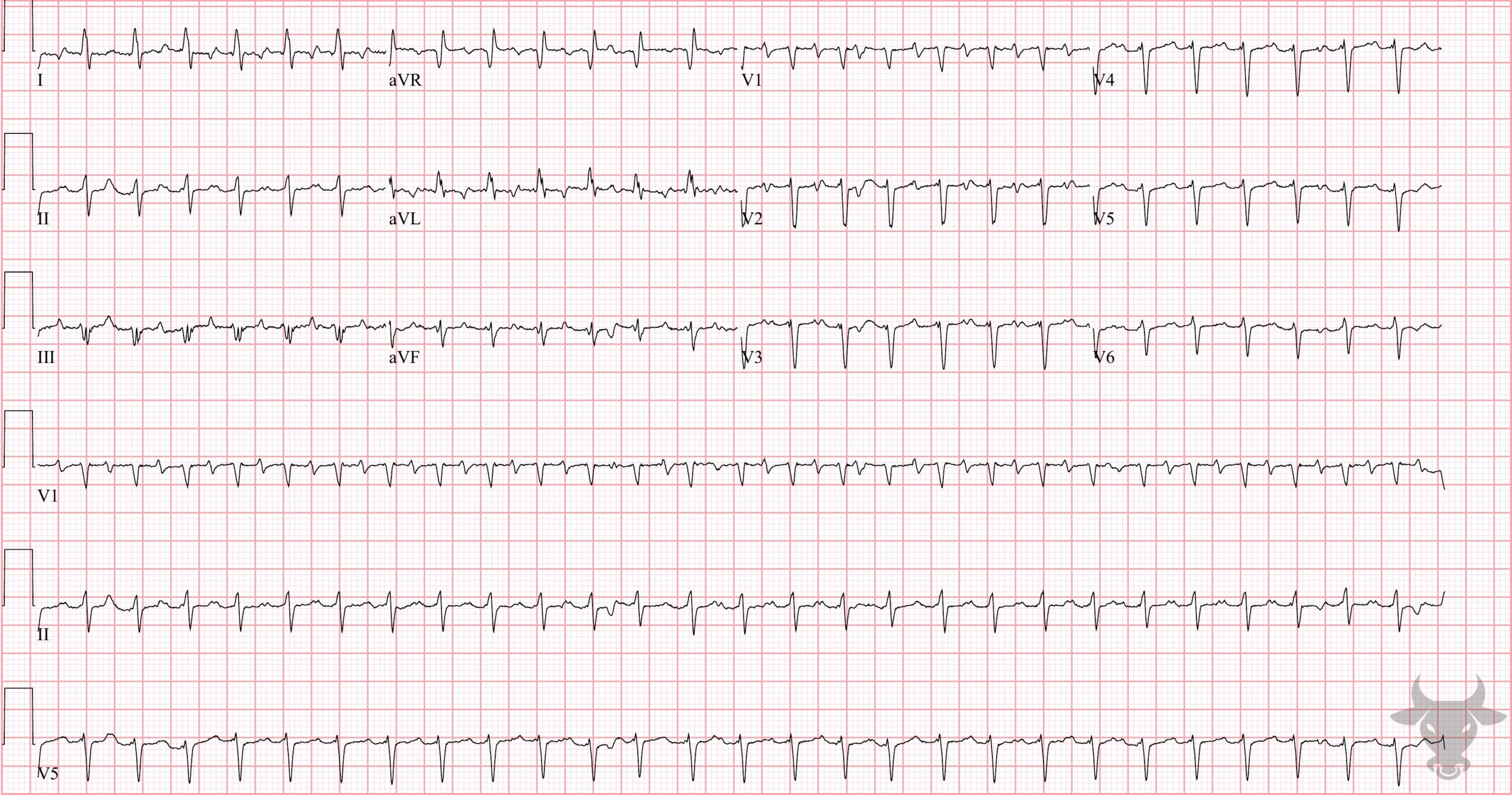 ECG Showing Atrial Tachycardia